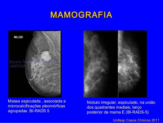Rastreamento e diagnóstico precoce do câncer de mama 19 set2012