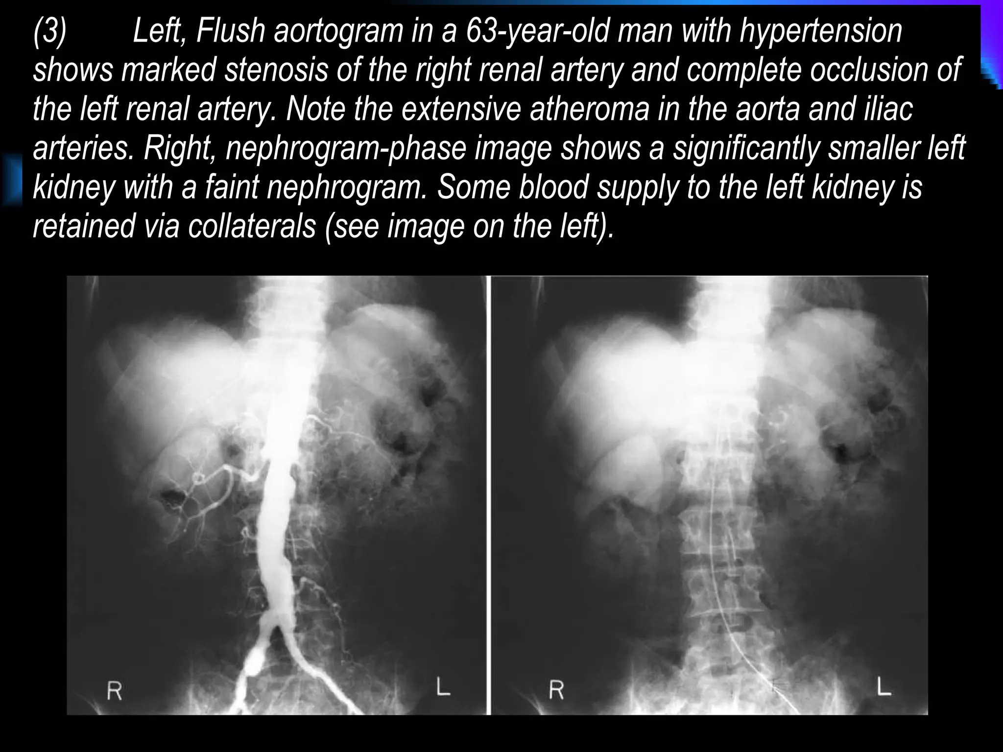 Renal Artery Stenosis | PPT