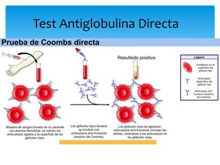 Test Antiglobulina Directa 
La prueba consiste  Administración 
de “antisuero” 
Antisuero Ac contra serie de 
antigenos en membrana GR 
Unión antisuero-GR Aglutinación 
Método Dg Reacciones 
transfusionales, Anemia Hemoliticas, 
etc. 
 