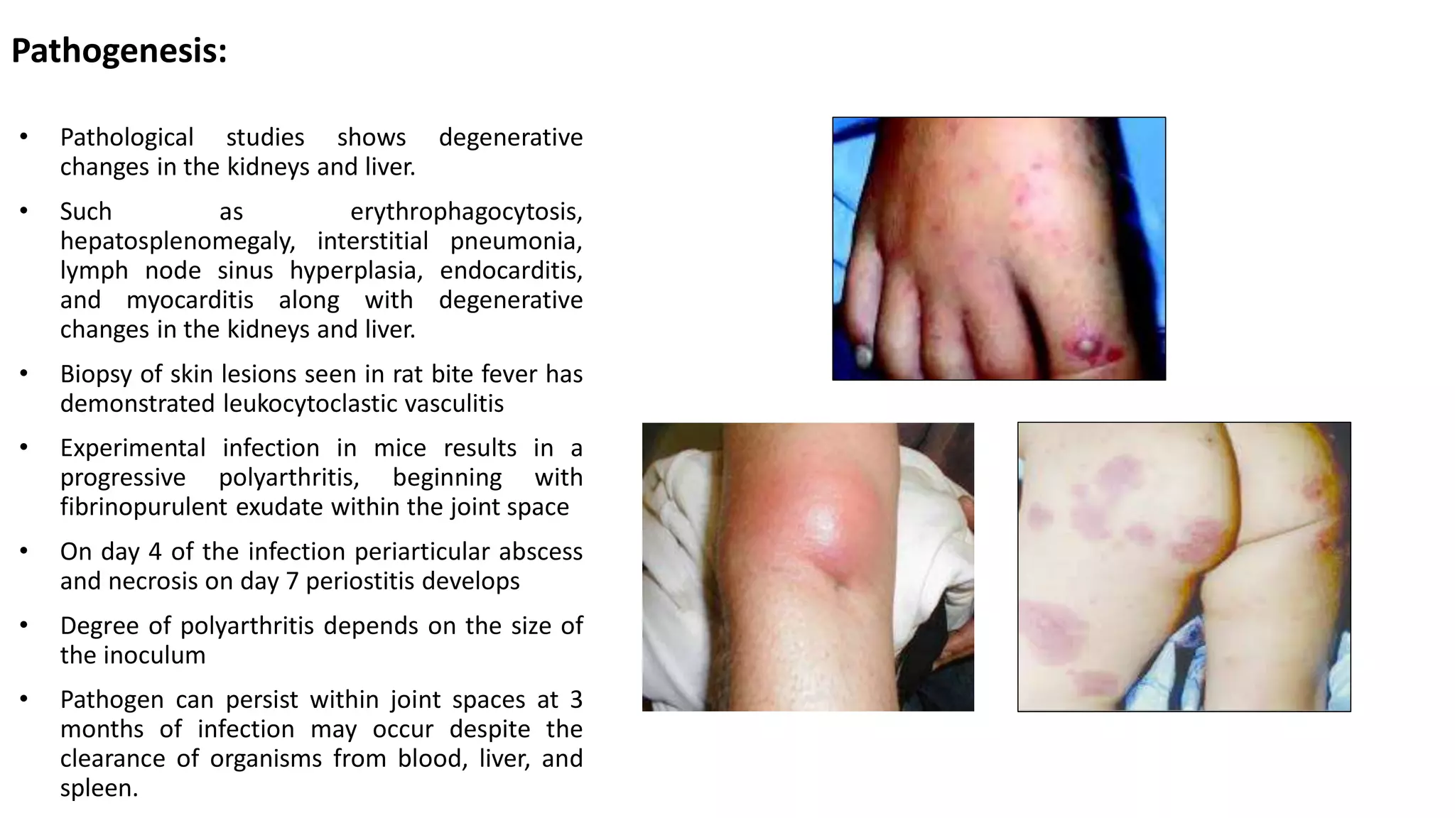 Rat bite fever | PDF