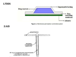 1.TDDS
2.IUD
 