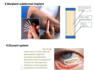 3.Norplant subdermal implant
4.Ocusert system
 