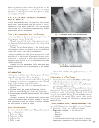 59
RationaleofEndodonticTreatment
pulpal and periapical lesions whereas the germ free rats did
not show any development of lesion. So he described
importance of microorganisms for the development of pulpal
and periapical pathologies.
PORTALS FOR ENTRY OF MICROORGANISMS
(FIGS 5.1 AND 5.2)
Though microorganisms may gain entry into pulp through
several routes, most common route for entering of micro-
organisms to dental pulp is dental caries. They can also gain
entry into pulp cavity via mechanical or traumatic injury, through
gingival sulcus and via bloodstream.
Entry of Microorganisms into Pulp Through
Dental caries—Caries is the most common way of entry of
microorganisms into the dental pulp.
Through open dentinal tubules-Microorganisms can pass
into the dentinal tubules and subsequently to the pulp resulting
in its necrosis.
Through the periodontal ligament or the gingival sulcus,
microorganisms can enter into the pulp via accessory and lateral
canals which connect pulp and the periodontium.
Anachoresis—Anachoresis refers to the attraction of blood
borne bacteria in the areas of inflammation. In other words,
anachoresis is a process by which microorganisms are
transported in the blood to an area of inflammation where they
establish an infection.
Through defective restorations, faulty restoration with
marginal leakage can result in contamination of the pulp by
bacteria.
INFLAMMATION
Inflammation is defined as the local response of living
mammalian tissue to injury due to any agent.
It is a body defense reaction in order to limit the spread
or eliminate it or to remove consequent necrosed cells and
tissues. Following agents cause inflammation:
a. Physical agents like cold, heat, mechanical trauma or
radiation.
b. Chemical agents like organic and inorganic poisons.
c. Infective agents like bacteria, viruses and their toxins.
d. Immunological agents like antigen-antibody cell mediated
reactions.
Therefore, we can say that inflammation is distinct from
infection. Inflammation is the protective response by the body,
while infection is invasion into the body by harmful microbes
and their resultant ill effects by toxins.
Signs of Inflammation
The roman writer celsus in 1st century AD gave four cardinal
signs of inflammation:
1. Rubor i.e. redness
2. Tumor i.e. swelling
3. Color i.e. heat
4. Dolor i.e. pain
Fig. 5.1: Radiograph showing poorly obturated canals
Fig. 5.2: Deep carious lesion resulting
in pulp necrosis and periapical lesion
Virchow later added the fifth sign function lasea, i.e. loss
of function.
Inflammation is of Two Types
• Acute inflammation dominated by PMNLs (Polymorpho-
nuclear lymphocytes) and few macrophages
• Chronic inflammation dominated by lymphocytes,
macrophages and plasma cells.
The balance between the host defense and microbial factor
determines the formation of lesion. In an infected canal, the
microbes are usually confined within the canal. As the blood
supply is compromised, the host defense mechanisms do not
totally eliminate the bacteria. These bacteria release certain
enzymes that stimulate the inflammatory process in the
periapical tissue.
TISSUE CHANGES FOLLOWING INFLAMMATION
As a result of inflammation, tissues exhibit two types of changes
viz degenerative changes and proliferative changes.
1. Degenerative changes in the pulp can be:
• Fibrous
• Resorptive
• Calcific.
Continuous degeneration of the tissue results in necrosis.
Suppuration is another form of degeneration which is due
 