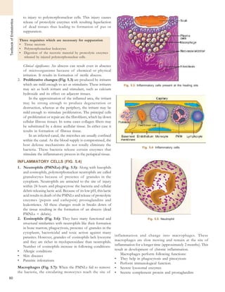 TextbookofEndodontics
to injury to polymorphonuclear cells. This injury causes
release of proteolytic enzymes with resulting liquefaction
of dead tissues thus leading to formation of pus or
suppuration.
Three requisites which are necessary for suppuration
• Tissue necrosis
• Polymorphonuclear leukocytes
• Digestion of the necrotic material by proteolytic enzymes
released by injured polymorphonuclear cells.
Clinical significance: An abscess can result even in absence
of microorganisms because of chemical or physical
irritation. It results in formation of sterile abscess.
2. Proliferative changes (Fig. 5.3) are produced by irritants
which are mild enough to act as stimulants. These irritants
may act as both irritant and stimulant, such as calcium
hydroxide and its effect on adjacent tissues.
In the approximation of the inflamed area, the irritant
may be strong enough to produce degeneration or
destruction, whereas at the periphery, the irritant may be
mild enough to stimulate proliferation. The principal cells
of proliferation or repair are the fibroblasts, which lay down
cellular fibrous tissues. In some cases collagen fibers may
be substituted by a dense acellular tissue. In either case it
results in formation of fibrous tissue.
In an infected canal, the microbes are usually confined
within the canal. As the blood supply is compromised, the
host defense mechanisms do not totally eliminate the
bacteria. These bacteria release certain enzymes that
stimulate the inflammatory process in the periapical tissue.
INFLAMMATORY CELLS (FIG. 5.4)
1 . Neutrophils (PMNLs) (Fig. 5.5): Along with basophils
and eosinophils, polymorphonuclear neutrophils are called
granulocytes because of presence of granules in the
cytoplasm. Neutrophils are attracted to the site of injury
within 24 hours and phagocytose the bacteria and cellular
debris releasing lactic acid. Because of its low pH, this lactic
acid results in death of the PMNLs and release of proteolytic
enzymes (pepsin and cathepsin) prostaglandins and
leukotrienes. All these changes result in breaks down of
the tissue resulting in the formation of an abscess (dead
PMNLs + debris).
2. Eosinophils (Fig. 5.6): They have many functional and
structural similarities with neutrophils like their formation
in bone marrow, phagocytosis, presence of granules in the
cytoplasm, bactericidal and toxic action against many
parasites. However, granules of eosinophils lack lysozyme
and they are richer in myeloperoxidase than neutrophils.
Number of eosinophils increase in following conditions:
• Allergic conditions
• Skin diseases
• Parasitic infestations
Macrophages (Fig. 5.7): When the PMNLs fail to remove
the bacteria, the circulating monocytes reach the site of
60
Fig. 5.3: Inflammatory cells present at the healing site
Fig. 5.4: Inflammatory cells
Fig. 5.5: Neutrophil
inflammation and change into macrophages. These
macrophages are slow moving and remain at the site of
inflammation for a longer time (approximately 2 months). This
result in development of chronic inflammation.
Macrophages perform following functions:
• They help in phagocytosis and pinocytosis
• Perform immunological function
• Secrete lysosomal enzymes
• Secrete complement protein and prostaglandins
 