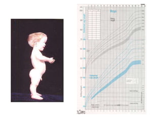 approach to short stature | PPTX