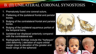 Anesthesia management of Craniosynostosis | PPTX