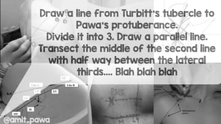 Draw a line from Turbitt’s tubercle to
Pawa’s protuberance.
Divide it into 3. Draw a parallel line.
Transect the middle of the second line
with half way between the lateral
thirds…. Blah blah blah
@amit_pawa
 