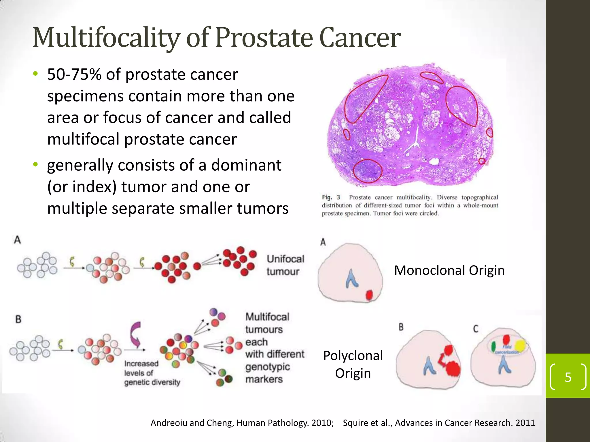 Multifocality of Prostate Cancer
• 50-75% of prostate cancer
specimens contain more than one
area or focus of cancer and called
multifocal prostate cancer
• generally consists of a dominant
(or index) tumor and one or
multiple separate smaller tumors
5
Andreoiu and Cheng, Human Pathology. 2010; Squire et al., Advances in Cancer Research. 2011
Monoclonal Origin
Polyclonal
Origin
 