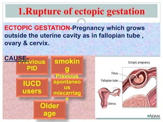 1.Rupture of ectopic gestation
Previous
PID
smokin
g
IUCD
users
Previous
spontaneo
us
miscarriag
e
Older
age
ECTOPIC GESTATION-Pregnancy which grows
outside the uterine cavity as in fallopian tube ,
ovary & cervix.
CAUSE-
 