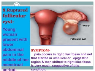 SYMPTOM-
pain occurs in right iliac fossa and not
that started in umbilical or epigastric
region & then shifted to right iliac fossa
is very much suggestive of this
condition.
8.Ruptured
follicular
cyst-
Young
woman
present with
lower
abdominal
pain in the
middle of her
menstrual
 