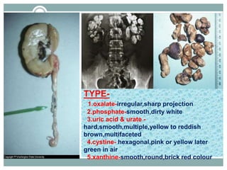 TYPE-
1.oxalate-irregular,sharp projection
2.phosphate-smooth,dirty white
3.uric acid & urate -
hard,smooth,multiple,yellow to reddish
brown,multifaceted
4.cystine- hexagonal,pink or yellow later
green in air
5.xanthine-smooth,round,brick red colour
 