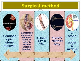 Surgical method
1.endosc
opic
stone
removal
2.ureterosc
opic stone
removal-
stone in
lower &
vesico-
ureteric
junction
3.lithotri
psy in
situ
4.urete
rolithot
omy
5.ESW
L-
stone
in
upper
&
middle
part
 