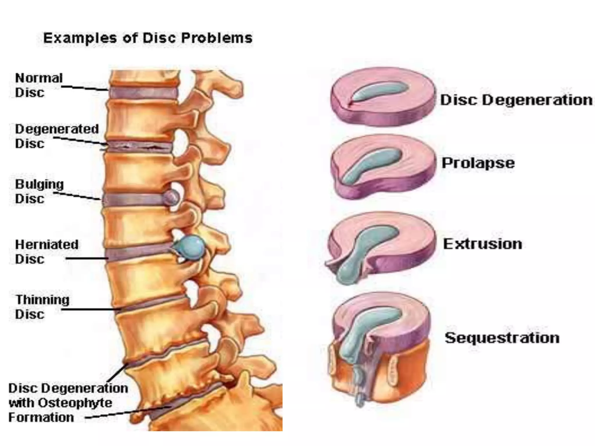 back pain algorithm ravi | PPT