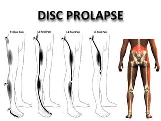 Disc Prolapse Classification back pain algorithm ravi | PPTX