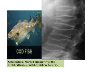 Metabolic Bone Diseases - RAVI | PPTX