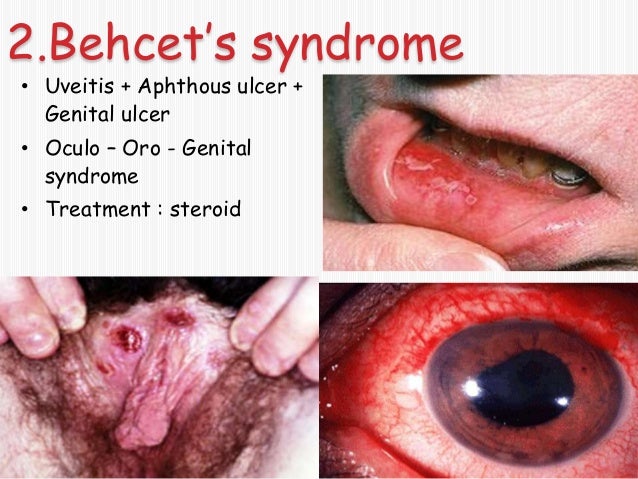 Herpes simplex | University of Maryland Medical Center