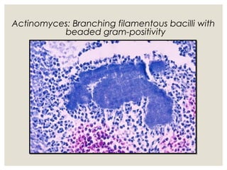 Actinomyces: Branching filamentous bacilli with
beaded gram-positivity
 