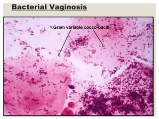 Bacterial Vaginosis
Gram variable cocco-bacilli
 