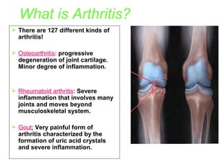 What is Arthritis?
 There are 127 different kinds of
arthritis!
 Osteoarthritis: progressive
degeneration of joint cartilage.
Minor degree of inflammation.

 Rheumatoid arthritis: Severe
inflammation that involves many
joints and moves beyond
musculoskeletal system.
 Gout: Very painful form of
arthritis characterized by the
formation of uric acid crystals
and severe inflammation.

 