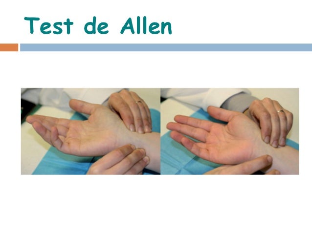 Fenómeno de Raynaud