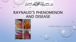RAYNAUD’S PHENOMENON
AND DISEASE
HAMAD EMAD H. DHUHAYR
 