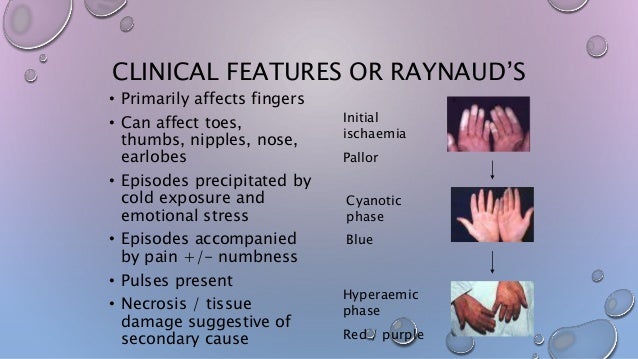 Raynaud