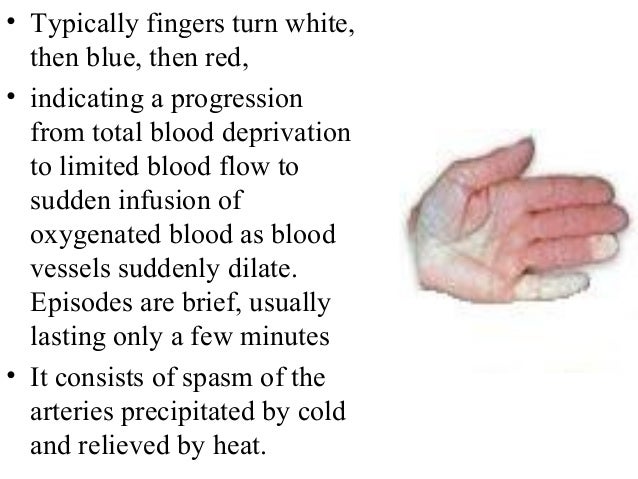 female raynaud