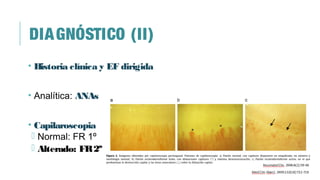 DIAGNÓSTICO (II)
• Historia clínica y EF dirigida
• Analítica: ANAs
• Capilaroscopia
 Normal: FR 1º
 Alterado: FR2º
 