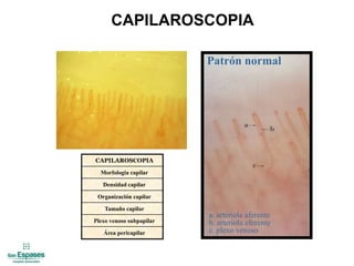 Capilaroscopia Normal Raynaud | PPTX