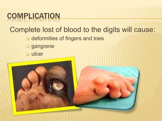COMPLICATION
Complete lost of blood to the digits will cause:
        deformities of fingers and toes
        gangrene
        ulcer
 