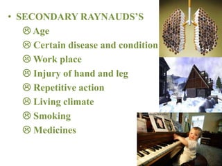 • SECONDARY RAYNAUDS’S
 Age
 Certain disease and condition
 Work place
 Injury of hand and leg
 Repetitive action
 Living climate
 Smoking
 Medicines
 