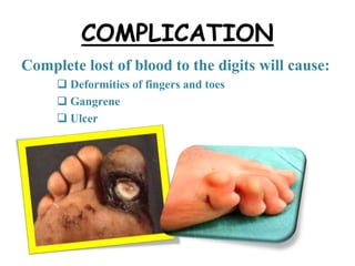 COMPLICATION
Complete lost of blood to the digits will cause:
 Deformities of fingers and toes
 Gangrene
 Ulcer
 