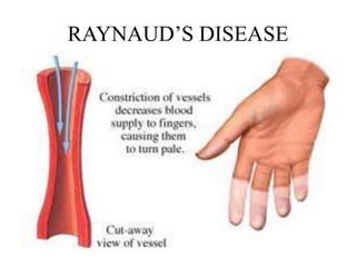 RAYNAUD’S DISEASE
 