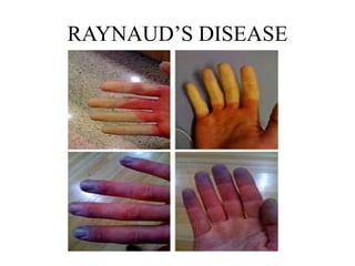 RAYNAUD’S DISEASE
 