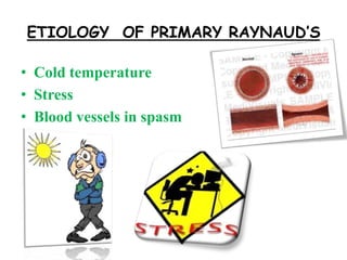 ETIOLOGY OF PRIMARY RAYNAUD’S
• Cold temperature
• Stress
• Blood vessels in spasm
 