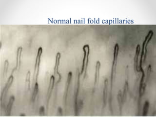 Normal nail fold capillaries
 