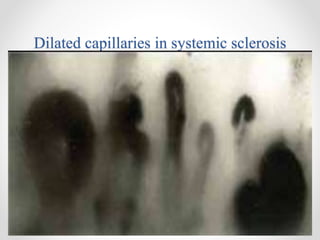 Dilated capillaries in systemic sclerosis
 