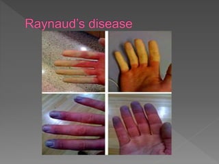 Raynauds disease | PPT
