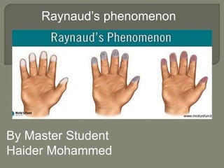 Raynaud’s phenomenon
By Master Student
Haider Mohammed
 
