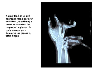 A este flaco se le hizo mierda la mano por tirar petardos  , tendrian que poner esta foto en los paquetes de pirotecnia. No le sirve ni para limpiarse los mocos ni otras cosas  