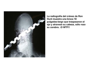 La radiografía del cráneo de Ron Hunt muestra una broca 18 pulgadas-largo que traspasaron el ojo y atravesó su cabeza, sólo rozo su cerebro. :O WTF!! 