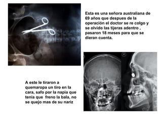 Esta es una señora australiana de 69 años que despues de la operación el doctor se re colgo y se olvido las tijeras adentro , pasaron 18 meses para que se dieran cuenta.  A este le tiraron a quemaropa un tiro en la cara, safo por la napia que tenia que  freno la bala, no se quejo mas de su nariz 