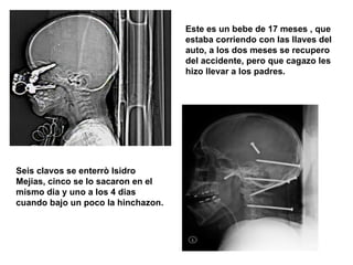 Este es un bebe de 17 meses , que estaba corriendo con las llaves del auto, a los dos meses se recupero del accidente, pero que cagazo les hizo llevar a los padres.  Seis clavos se enterrò Isidro Mejias, cinco se lo sacaron en el mismo dia y uno a los 4 dias cuando bajo un poco la hinchazon. 