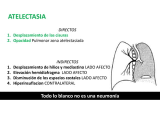 DIRECTOS 
ATELECTASIA 
1. Desplazamiento de las cisuras 
2. Opacidad Pulmonar zona atelectasiada 
INDIRECTOS 
1. Desplazamiento de hilios y mediastino LADO AFECTO 
2. Elevación hemidiafragma LADO AFECTO 
3. Disminución de los espacios costales LADO AFECTO 
4. Hiperinsuflacion CONTRALATERAL 
Todo lo blanco no es una neumonía 
 