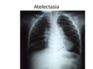 Atelectasia 
 