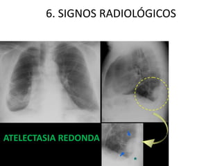 6. SIGNOS RADIOLÓGICOS 
ATELECTASIA REDONDA 
 