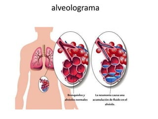 alveolograma 
 
