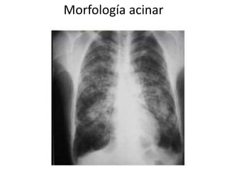 Morfología acinar 
 