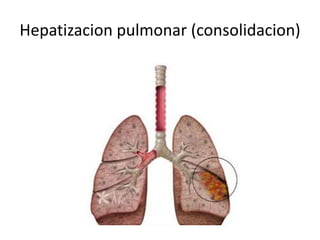Hepatizacion pulmonar (consolidacion) 
 