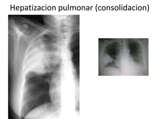 Hepatizacion pulmonar (consolidacion) 
 